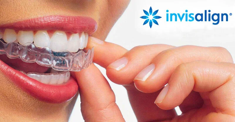 invisalign
