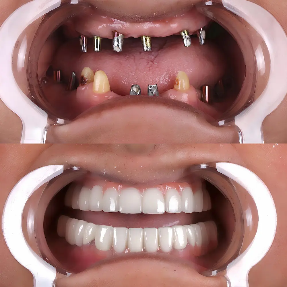 Implantes dentales en Clínica Doctores Cristobal