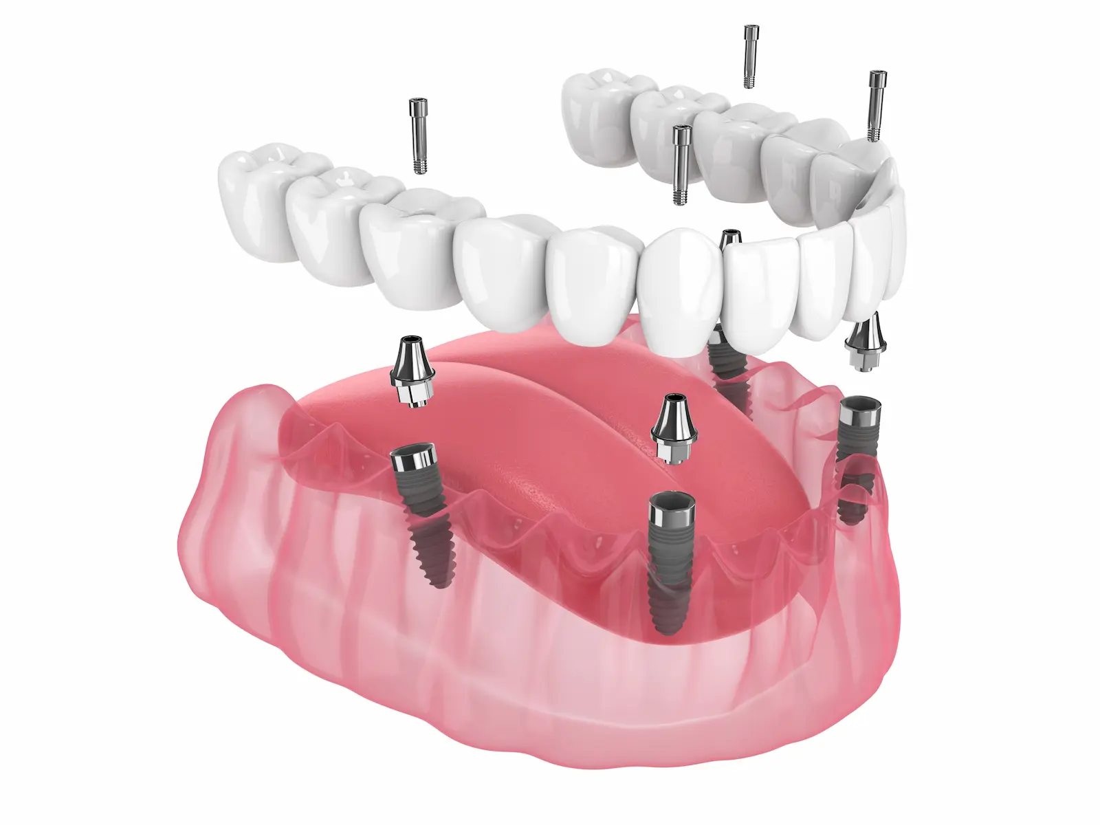Implantología Tratamiento dental
